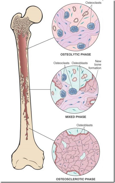 Pathogenesis of bone disorders